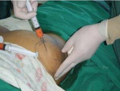 自體脂肪豐臀的缺點(diǎn)