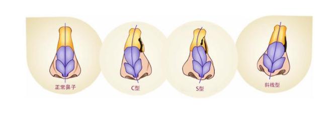 歪鼻矯正手術(shù)的創(chuàng)傷大嗎？鼻子有點兒歪