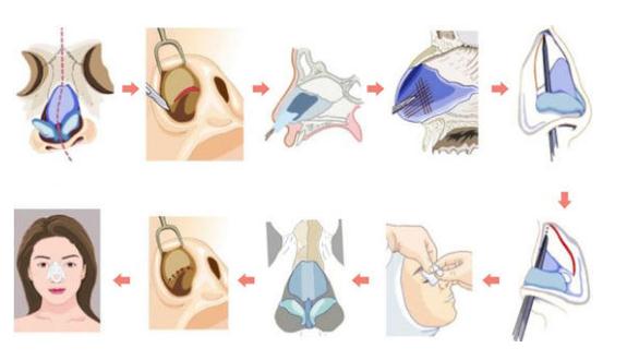 歪鼻矯正手術(shù)的創(chuàng)傷大嗎？