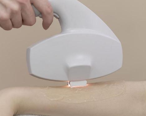 冰點脫毛能維持多久?