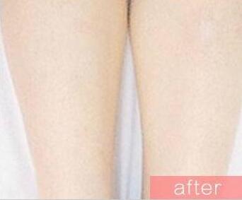 冰點脫毛應該間隔多久呢?