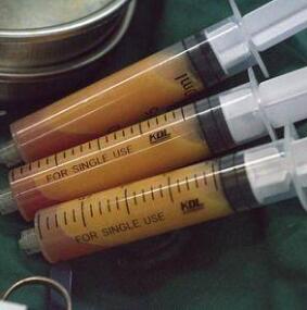 大腿吸脂術(shù)后