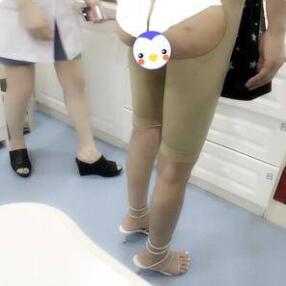 大腿吸脂術(shù)后