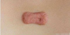 瘢痕疙瘩調(diào)節(jié)：疤痕體質(zhì)打耳洞容易長疙瘩？