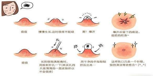 面部痤瘡一般怎么解決？有哪些解決方式？
