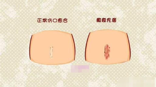 耳朵長瘢痕疙瘩是疤痕體質(zhì)嗎?