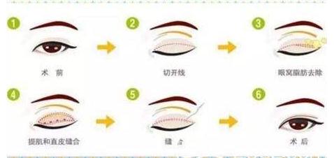 全切雙眼皮拆線之后可以化妝了嗎？