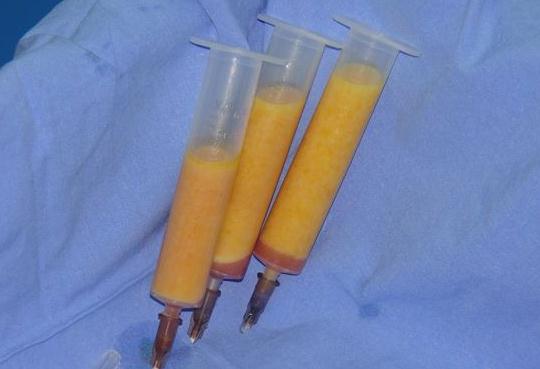 面部脂肪填充過量，術(shù)后果不好看，該怎么辦呢?