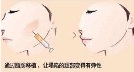 面部脂肪填充過量，按壓和吸脂可以解決這個問題嗎?