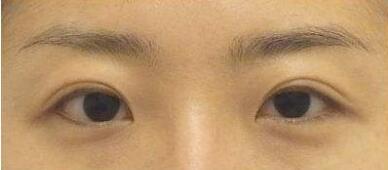 網(wǎng)傳的牙膏去眼袋有用嗎?