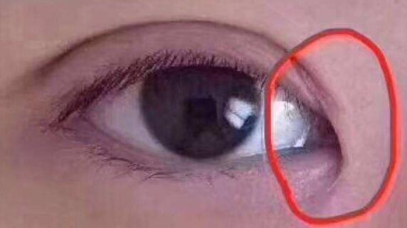 什么樣的眼睛需要開眼角?