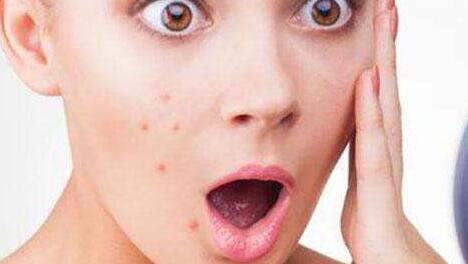 成人臉上的痤瘡形成的原因是什么呢?