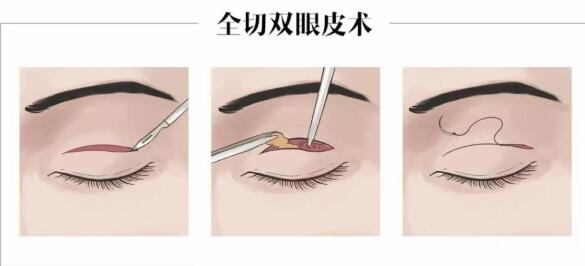 全切雙眼皮拆線之后可以化妝了嗎?