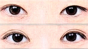 全切雙眼皮拆線之后的注意事項