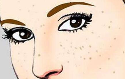 超聲波祛雀斑會(huì)不會(huì)出現(xiàn)反彈?