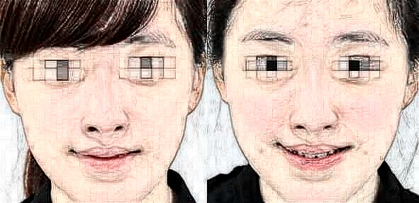 部脂肪填充過量修復(fù)的注意事項(xiàng)