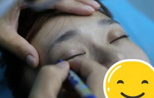 做完雙眼皮全切后會(huì)不會(huì)出現(xiàn)腫脹現(xiàn)象?