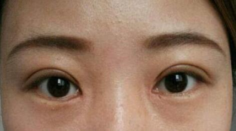 做完雙眼皮全切后一直不消腫是怎么回事?