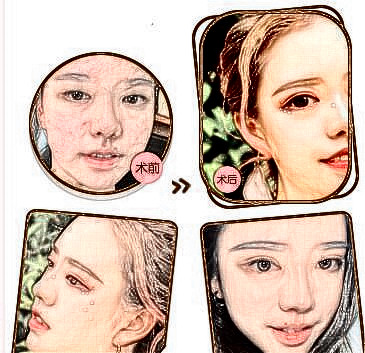 雙眼皮手術(shù)案例