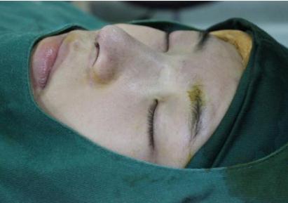 做完鼻部手術手術后長時間可以戴近視眼鏡呢?