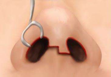 做綜合隆鼻手術(shù)的恢復(fù)期大概是多長時間？