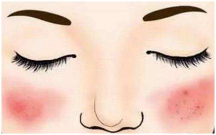 關于激光去紅血絲，一些你必須要知道的事兒~