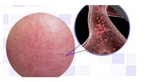 激光去除紅血絲的危害及副作用