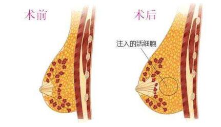 為什么有些人不適合做自體脂肪隆胸?