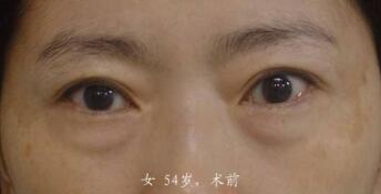 激光祛眼袋的果怎么樣呢？