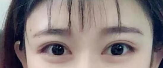 激光祛眼袋多少錢?