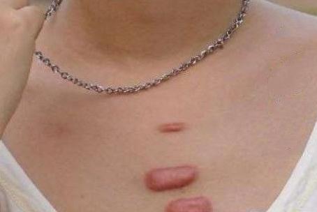 胸前有疤痕疙瘩應(yīng)該怎么辦？要怎樣調(diào)節(jié)？