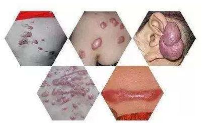 瘢痕疙瘩是怎么回事？