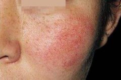 激光去紅血絲沒(méi)問(wèn)題嗎？一點(diǎn)都不喜歡“高原紅”