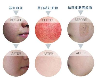 激光祛紅血絲沒問題嗎?