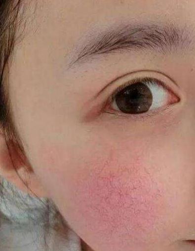 激光紅血絲會(huì)反彈嗎？