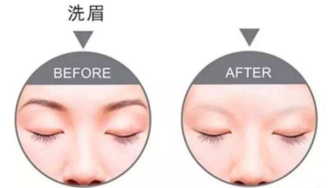 激光洗眉的原理