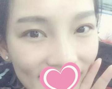 到長沙愛**做了扇形雙眼皮術(shù)后第30天