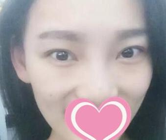 到長沙愛**做了扇形雙眼皮術(shù)后第35天