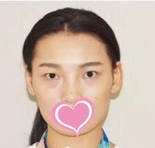 到長沙愛**做了扇形雙眼皮術(shù)前