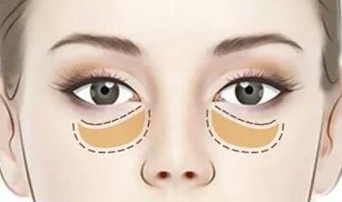 韓式微創(chuàng)手術(shù)去眼袋優(yōu)勢