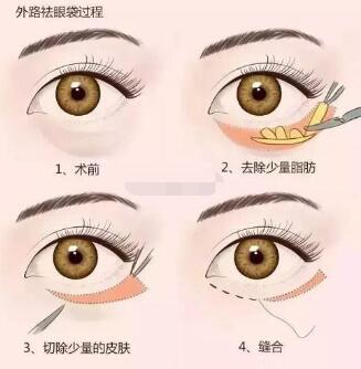 韓式微創(chuàng)手術(shù)去眼袋優(yōu)勢