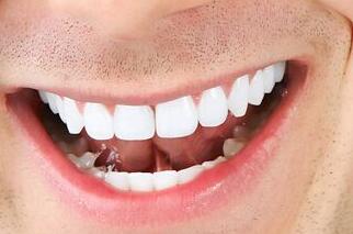 拔牙后的注意事項