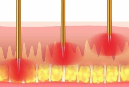 激光去紅血絲會(huì)反彈嗎？