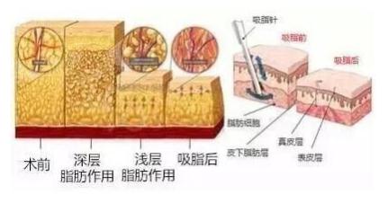 抽脂后不均勻主要與以下因素有關(guān)