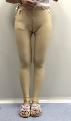 小腿抽脂的優(yōu)勢