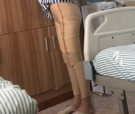 小腿抽脂會(huì)不會(huì)容易反彈?