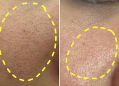 去黑頭小竅門：這幾個(gè)方法很有！