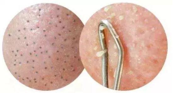 去除化妝油和黑頭