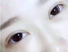 做完雙眼皮之后眼睛睜不開，是這些因素~