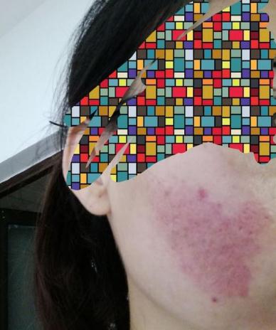 點(diǎn)陣激光祛痘原理